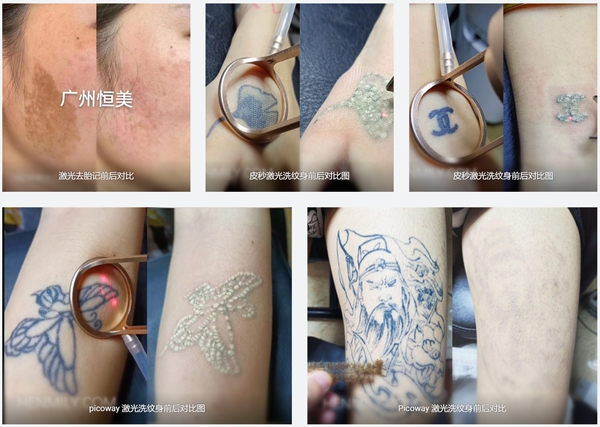 如何检查调Q激光洗纹身机的质量？
