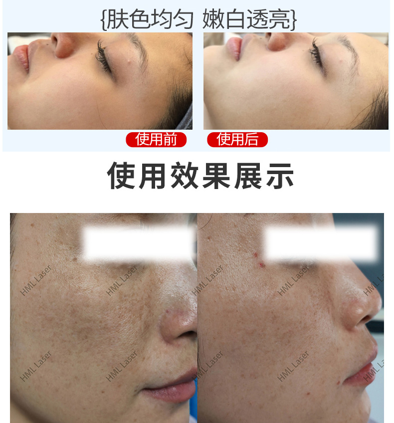 光子嫩肤效果1.jpg